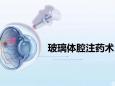 德江县民族中医院眼科成功开展玻璃体腔注药术
