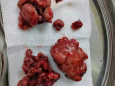 德江县民族中医院肛肠科成功为一12岁孩子开展直肠巨大息肉摘除手术